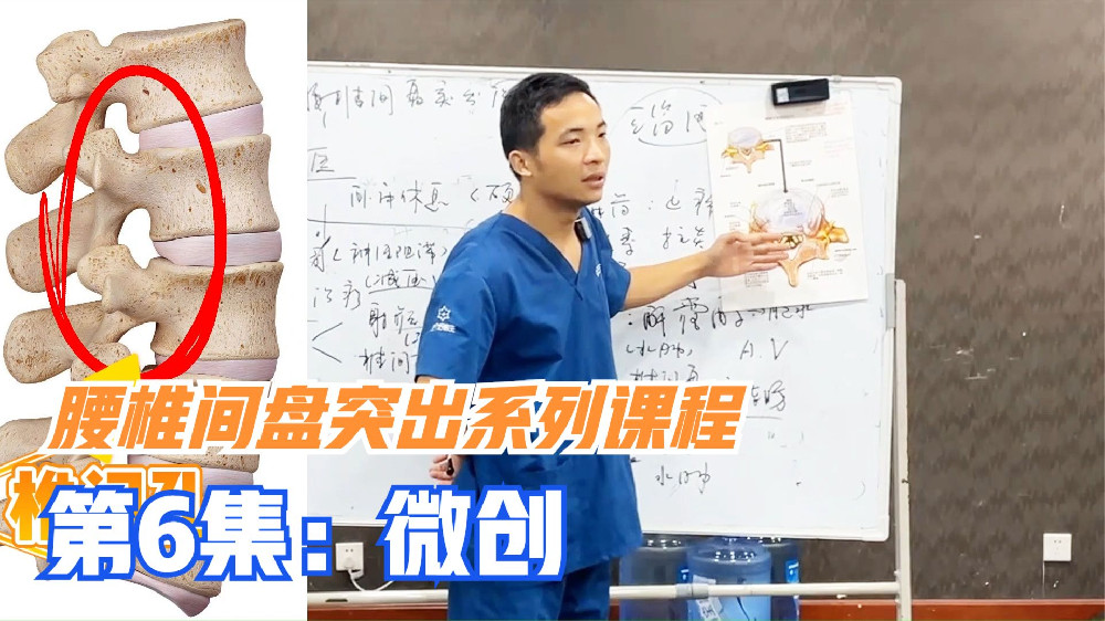射频消融术和椎间孔镜，是2个常见微创手术，腰椎间盘突出效果好